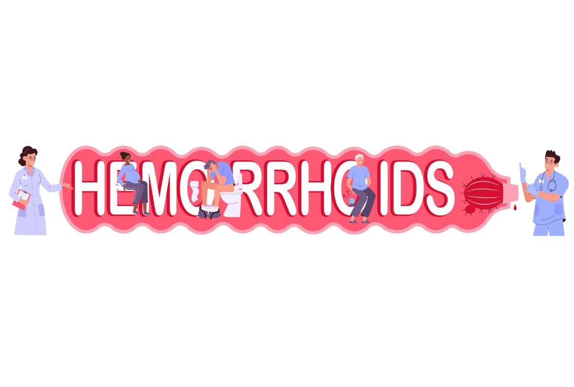 Hemorrhoid