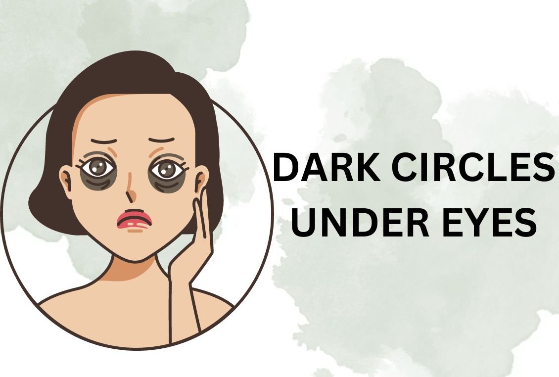 How to Cover Dark Circles Naturally