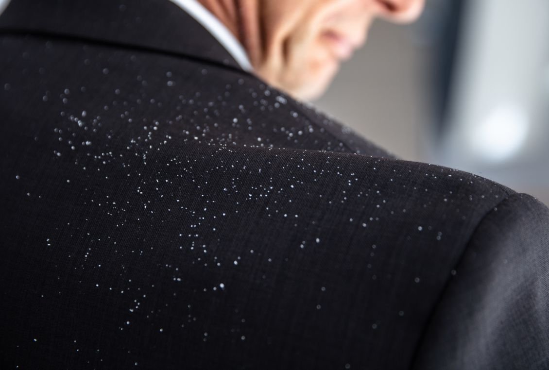 Hair Dandruff Herbal Treatment