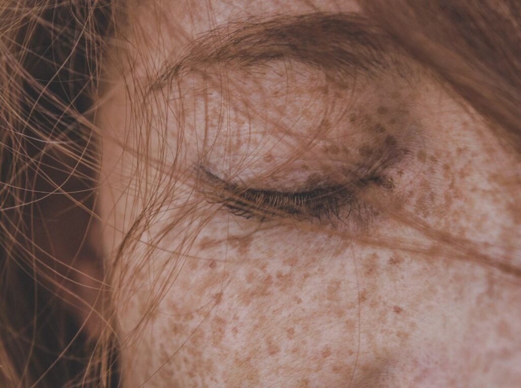 how to get rid of freckles