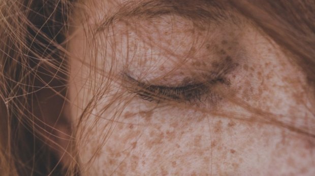 how to get rid of freckles