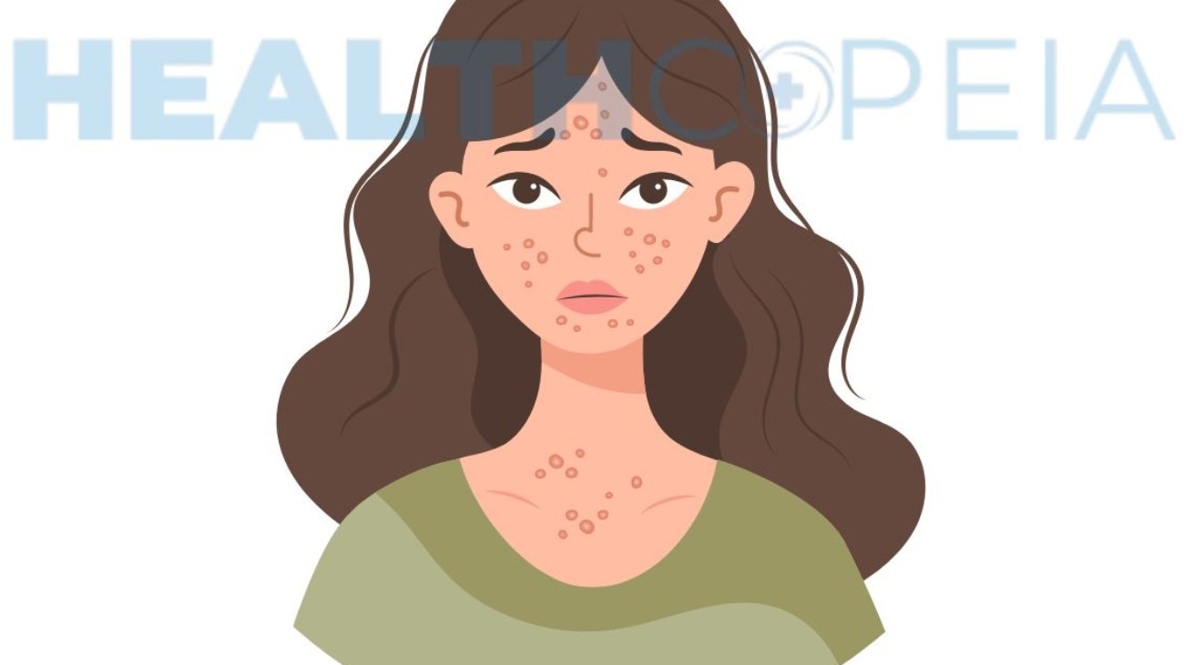 White Spots on Skin