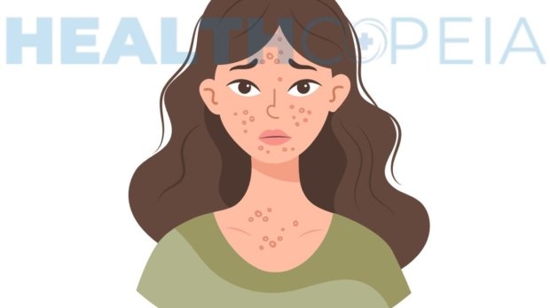 White Spots on Skin